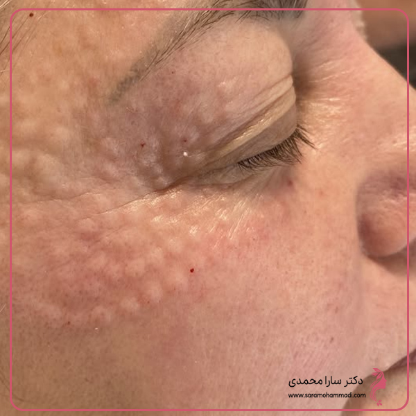 ریشه‌یابی علت تیرگی و گودی: مزوژل برای چه کسانی موثر است؟