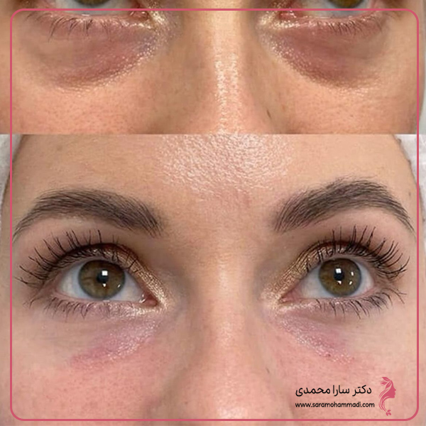معرفی و ارزیابی برندهای برتر مزوژل زیر چشم