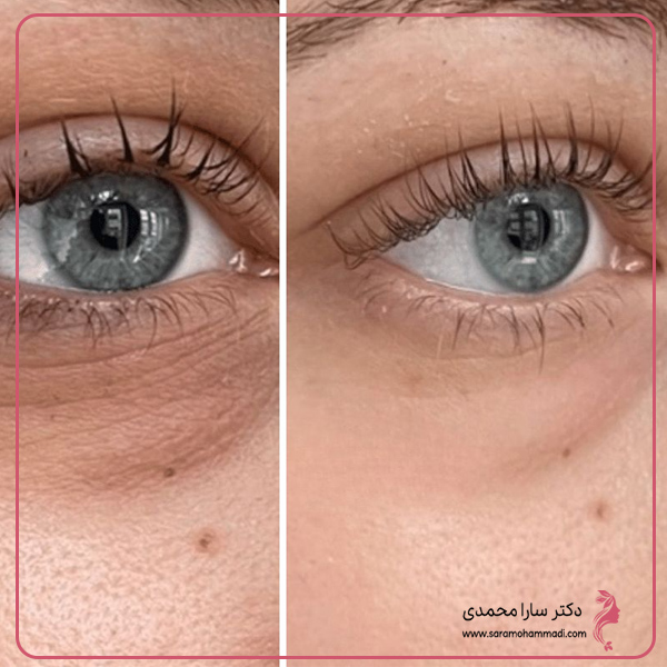 روش ها و تکنیک های تزریق مزوژل زیر چشم