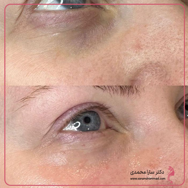 مراقبت های بعد از تزریق مزوژل زیر چشم