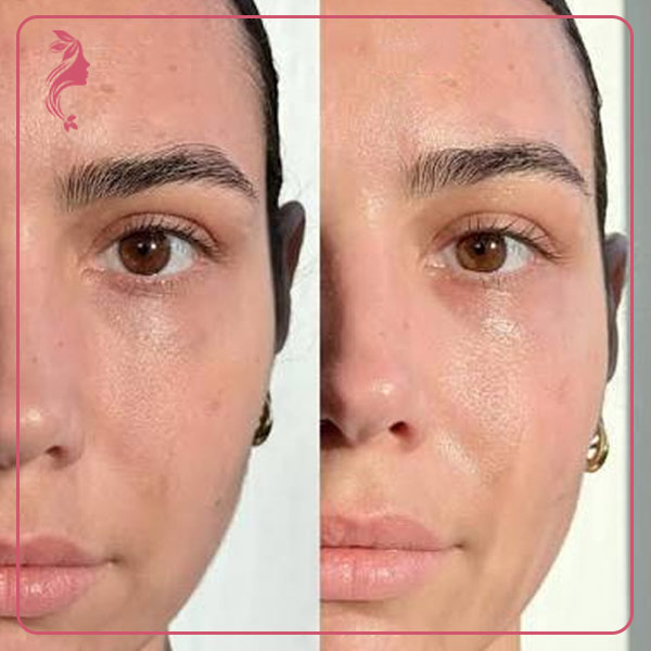 نمونه فیشیال پوست خشک کلینیک دکتر سارا محمدی