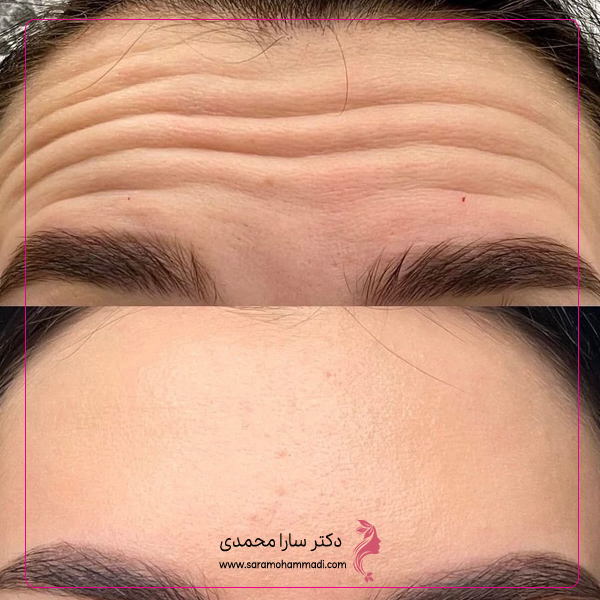مراقبت های قبل و بعد از بوتاکس