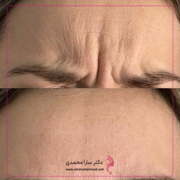 توصیه های دکتر سارا محمدی در زمینه مراقبت های قبل و بعد از بوتاکس