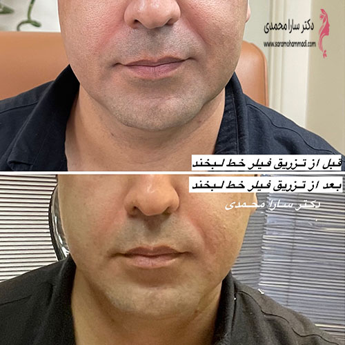 نمونه فیلر خط خنده برای آقایان قبل و بعد