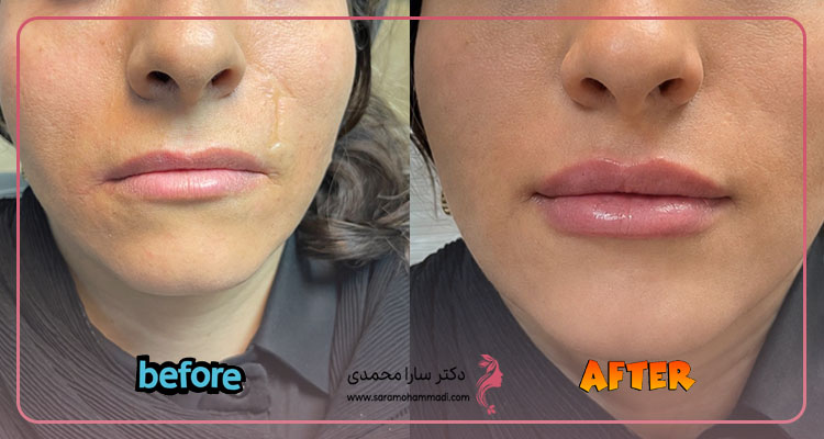 نمونه تزریق فیلر لب در فردیس قبل و بعد