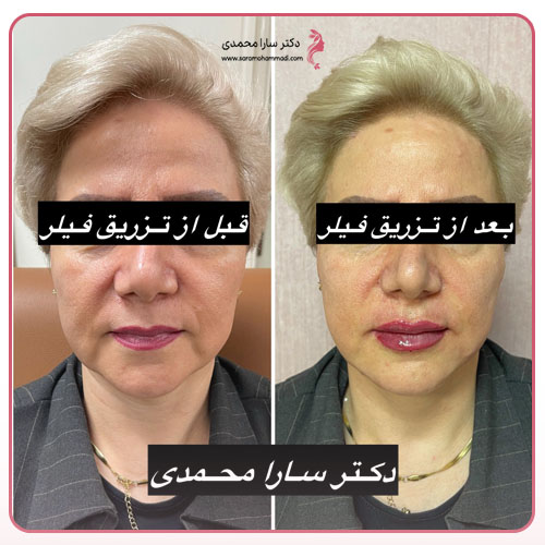 تزریق فیلر لب قبل و بعد در کرج