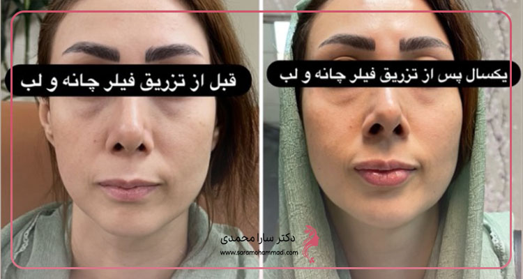 تزریق فیلر چانه و لب قبل و بعد در فردیس