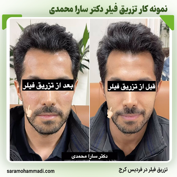 نمونه تزریق قلیر برای مردان