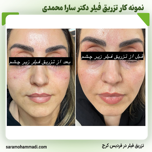 تزریق-فیلر-زیر-چشم-در-فردیس