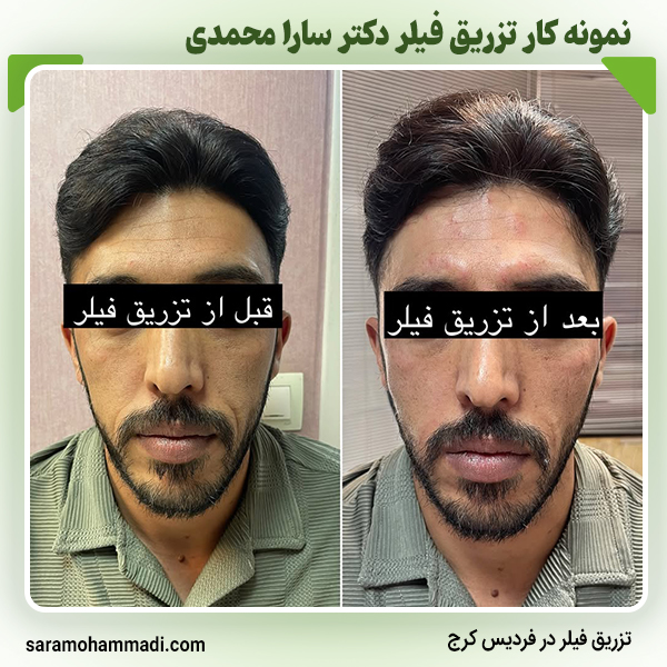 تزریق فیلر برای آقایان در فردیس