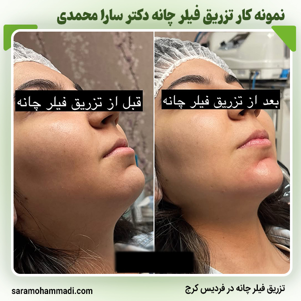 تزریق فیلر چانه در فردیس