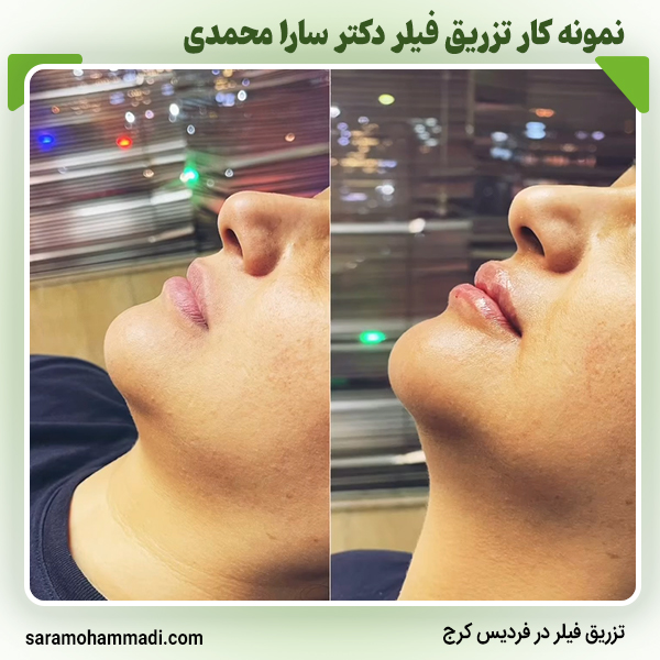 نمونه کار تزریق فیلر در فردیس