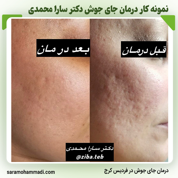 درمان جای جوش در فردیس