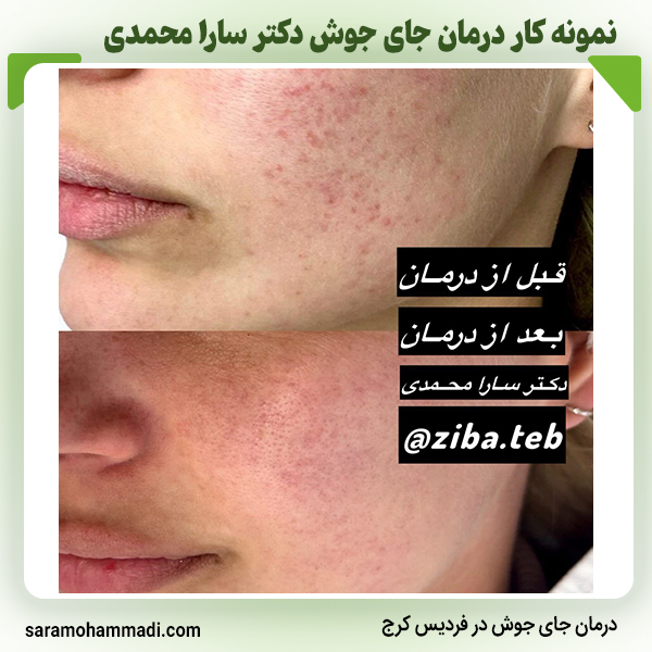 بهترین مرکز درمان جای جوش در فردیس