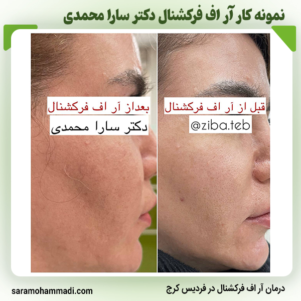 بهترین مرکز آر اف فرکشنال در فردیس