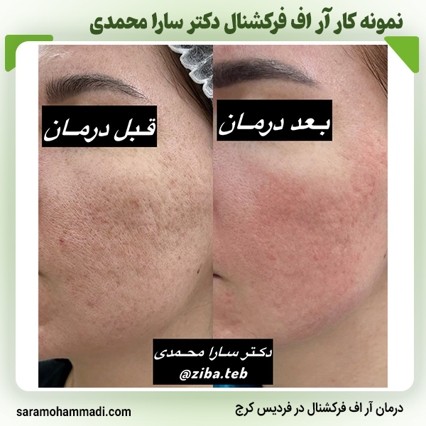 نمونه کار آر اف فرکشنال در فردیس
