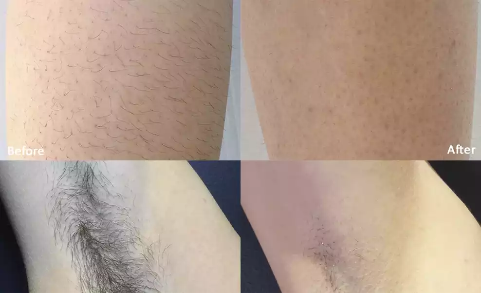 نمونه قبل و بعد لیزر زیر بغل و پا پس از جلسه چهارم