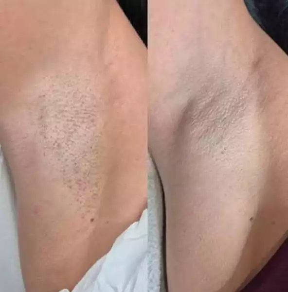 نمونه قبل و بعد لیزر موهای زائد زیر بغل