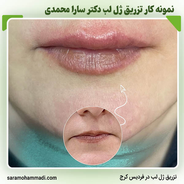 نمونه کار ژل لب در فردیس