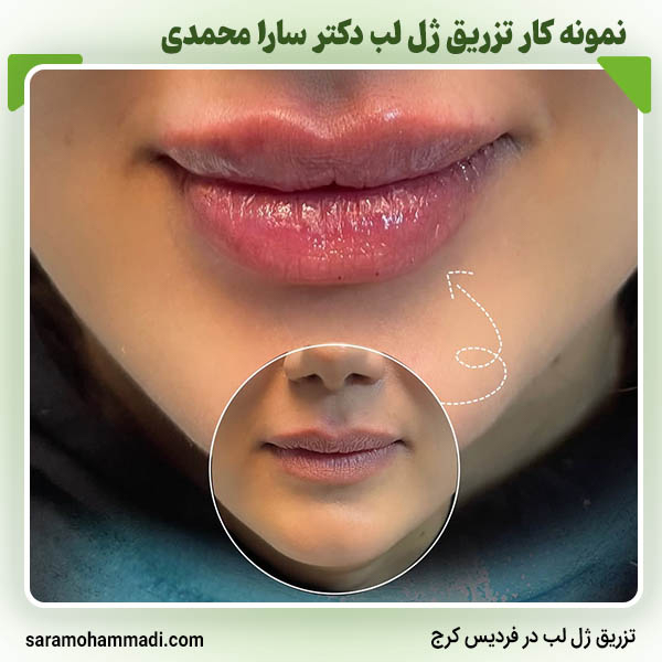 تزریق ژل لب در فردیس