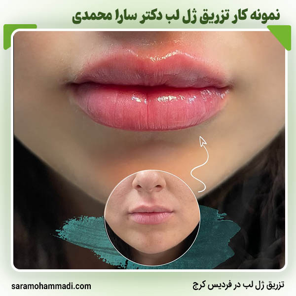 تزریق ژل لب در فردیس کرج