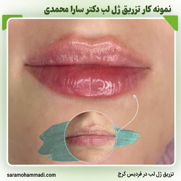 تزریق ژل لب در کرج