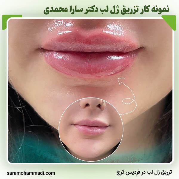 نمونه کار تزریق ژل لب