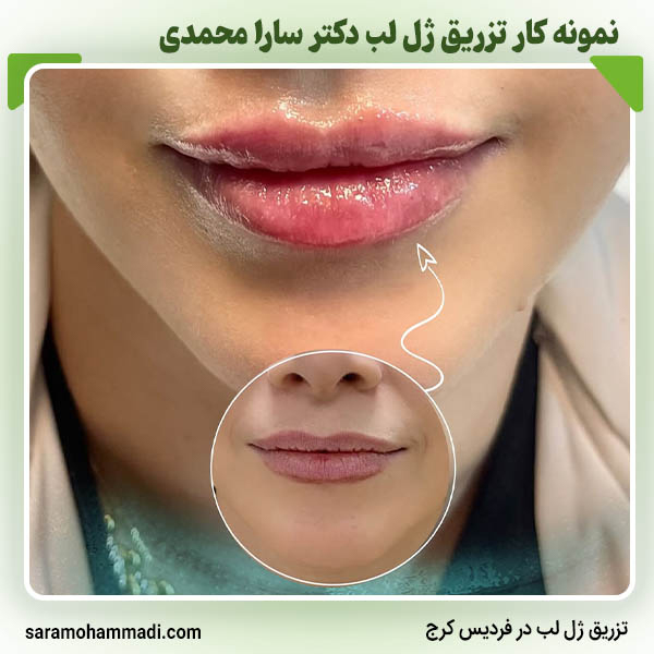 نمونه کار تزریق ژل لب در فردیس