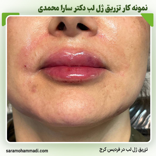 مراقبت های بعد از تزریق ژل لب در فردیس