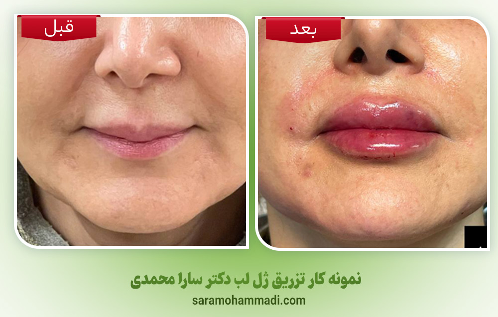 تزریق ژل لب در فردیس با ماندگاری بالا و فرم طبیعی
