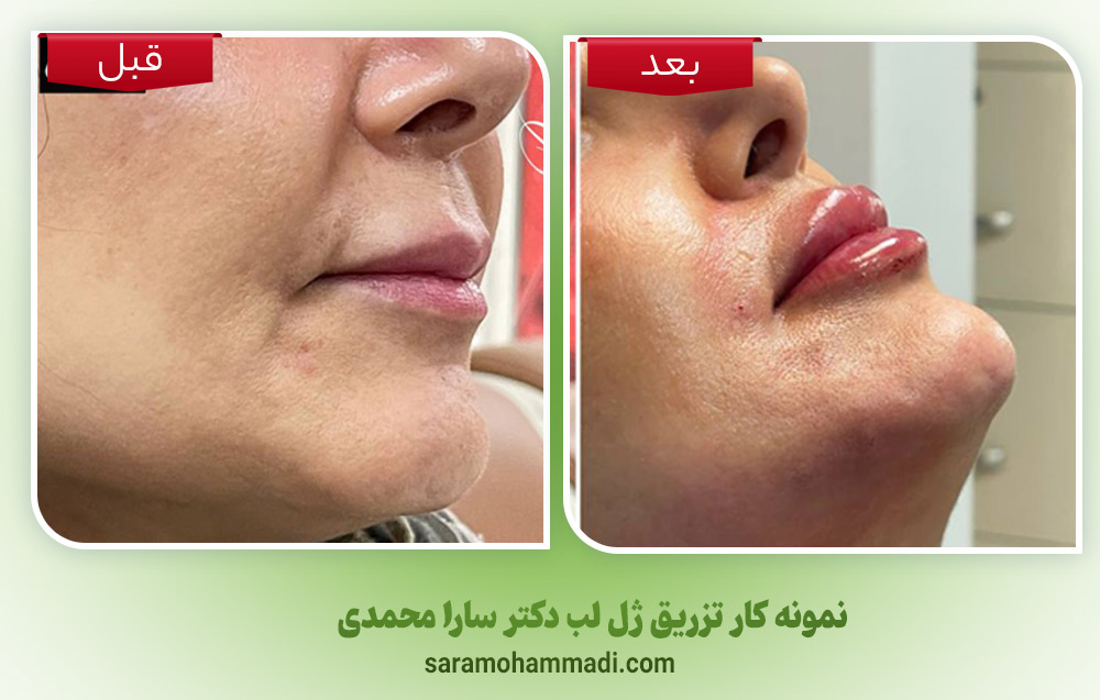 بهترین مرکز تزریق ژل لب در فردیس