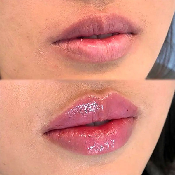 نمونه کار تزریق ژل لب مدل روسی در فردیس دکتر سارا محمدی