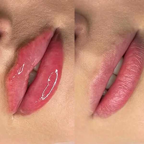 نمونه کار تزریق ژل لب مدل روسی در فردیس دکتر سارا محمدی
