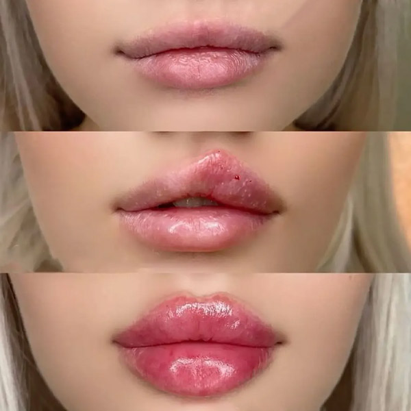 نمونه کار تزریق ژل لب مدل فانتزی در فردیس دکتر سارا محمدی