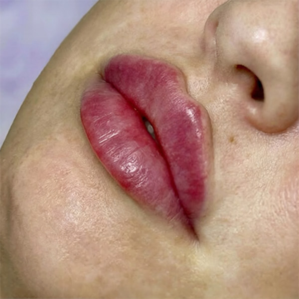 نمونه کار تزریق ژل لب مدل قلبی در فردیس دکتر سارا محمدی