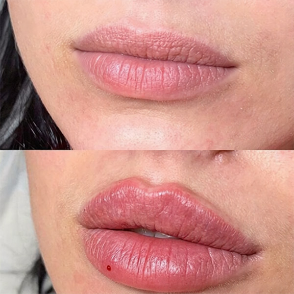نمونه کار تزریق ژل لب مدل قلبی در فردیس دکتر سارا محمدی
