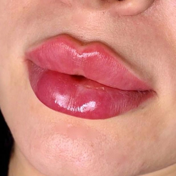 نمونه کار تزریق ژل لب قلوه‌ای در فردیس دکتر سارا محمدی