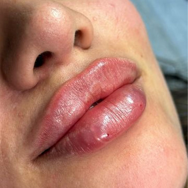 نمونه کار تزریق ژل لب قلوه‌ای در فردیس دکتر سارا محمدی