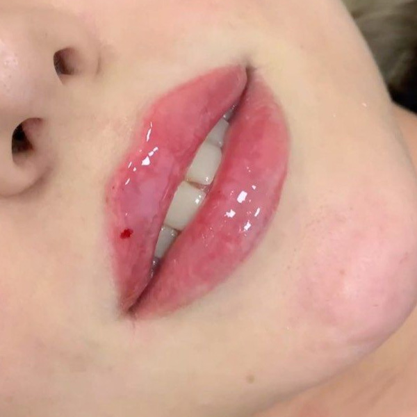 نمونه کار تزریق ژل لب نچرال در فردیس دکتر سارا محمدی
