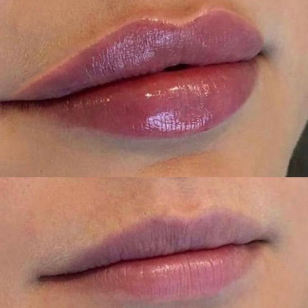 نمونه کار تزریق ژل لب نچرال در فردیس دکتر سارا محمدی