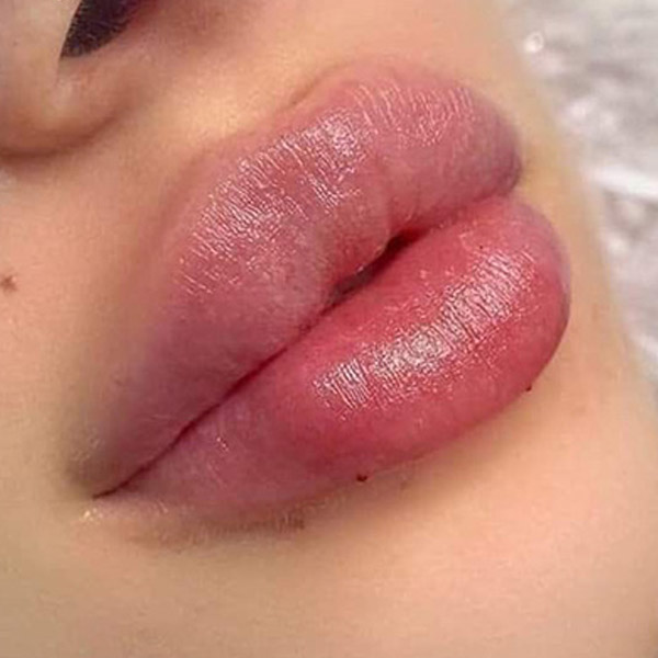 نمونه کار تزریق ژل لب مدل گرد در فردیس دکتر سارا محمدی