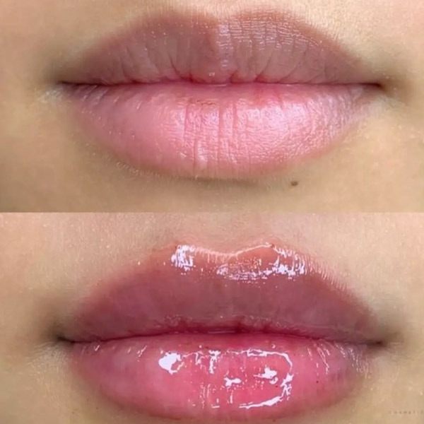 نمونه کار تزریق ژل لب مدل گرد در فردیس دکتر سارا محمدی