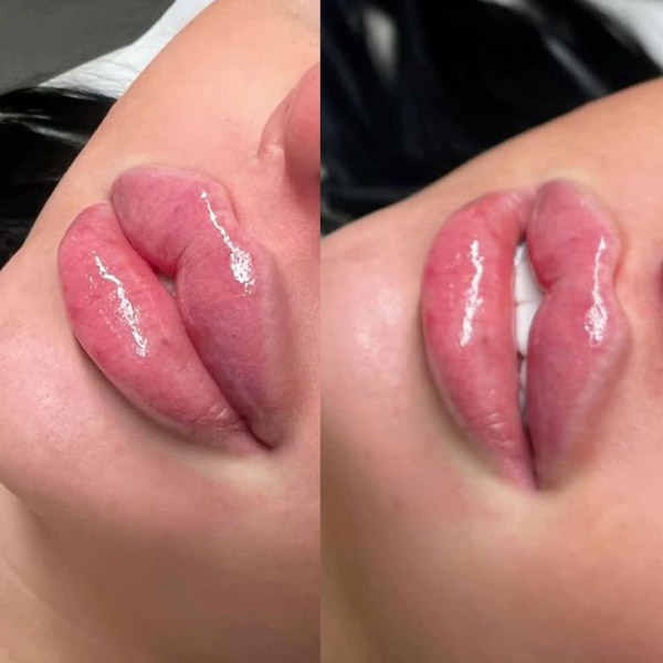 نمونه کار تزریق ژل لب عروسکی چاکدار در فردیس دکتر سارا محمدی