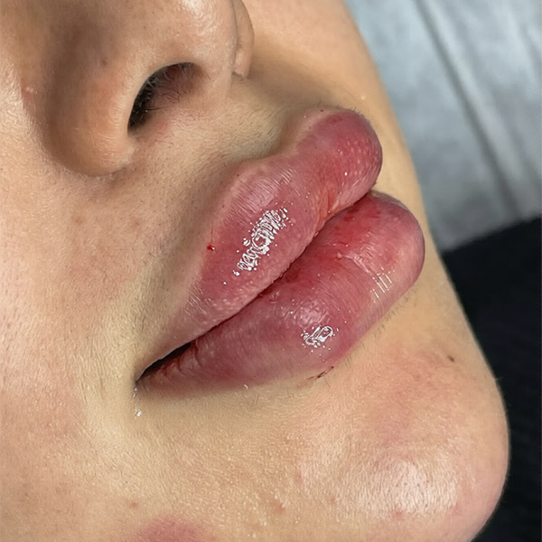 نمونه کار تزریق ژل لب عروسکی چاکدار در فردیس دکتر سارا محمدی