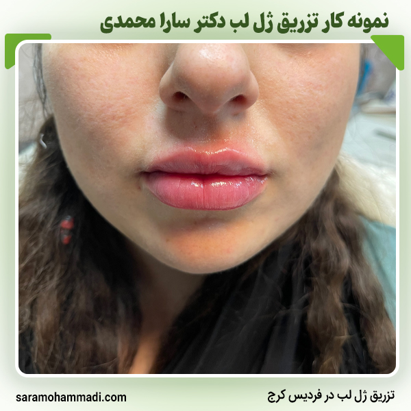 تزریق ژل لب در فردیس کرج
