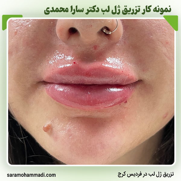 قیمت تزریق ژل لب در فردیس کرج