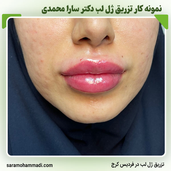 نمونه کار ژل لب در فردیس کرج