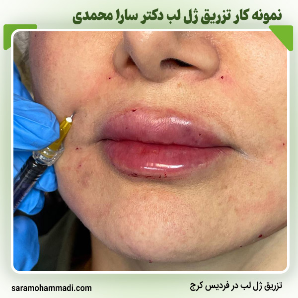 برندهای ژل لب برای تزریق ژل لب در فردیس