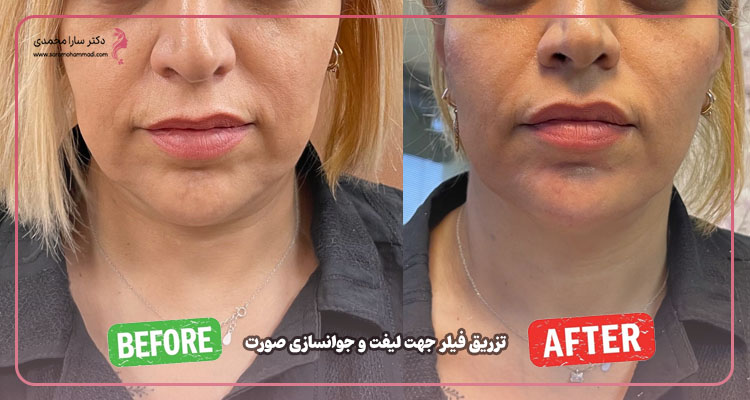 لیفت صورت با فیلر قبل و بعد