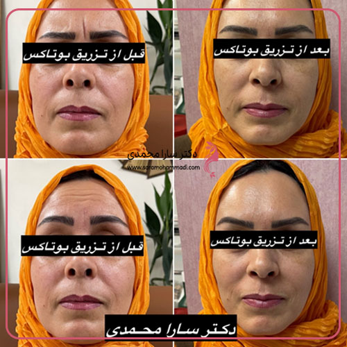 بوتاکس خط اخم و لیفت ابرو (قبل و بعد)